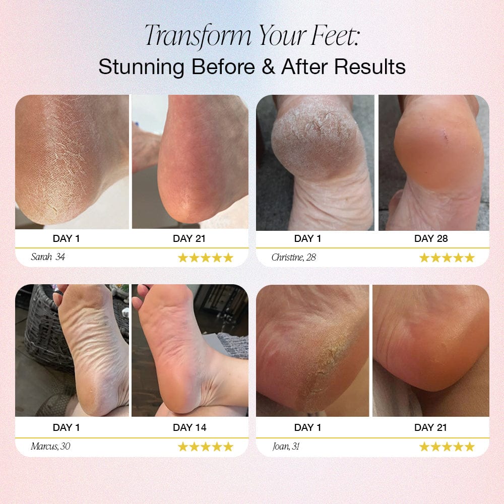 Dream Motto™ Electric Foot Callus Remover