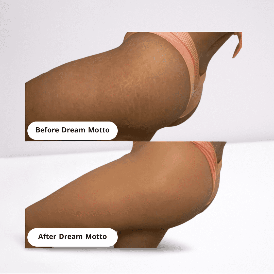 DreamMotto™ Full Body Coverage Perfector-DreamMotto™