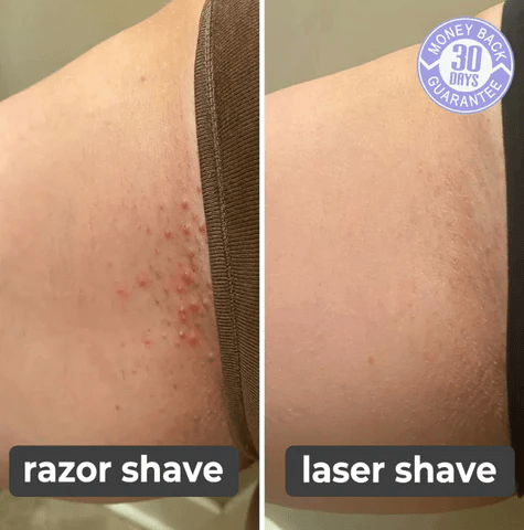 DreamMotto Laser Hair Remover
