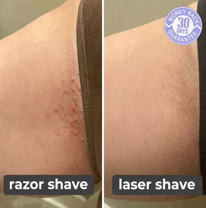 DreamMotto Laser Hair Remover